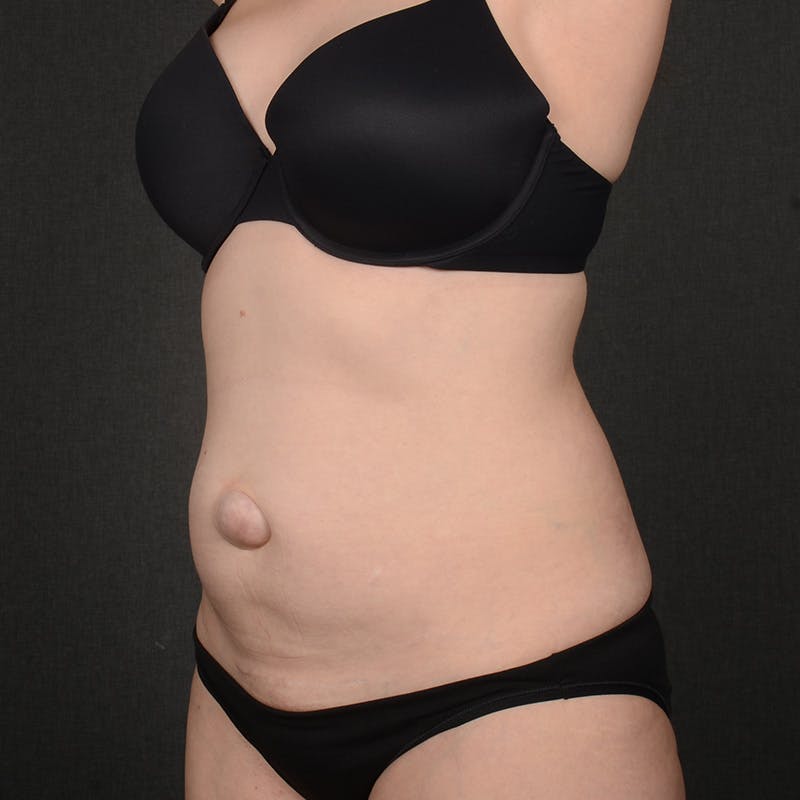 Tummy Tuck Before & After Gallery - Patient 860421 - Image 3