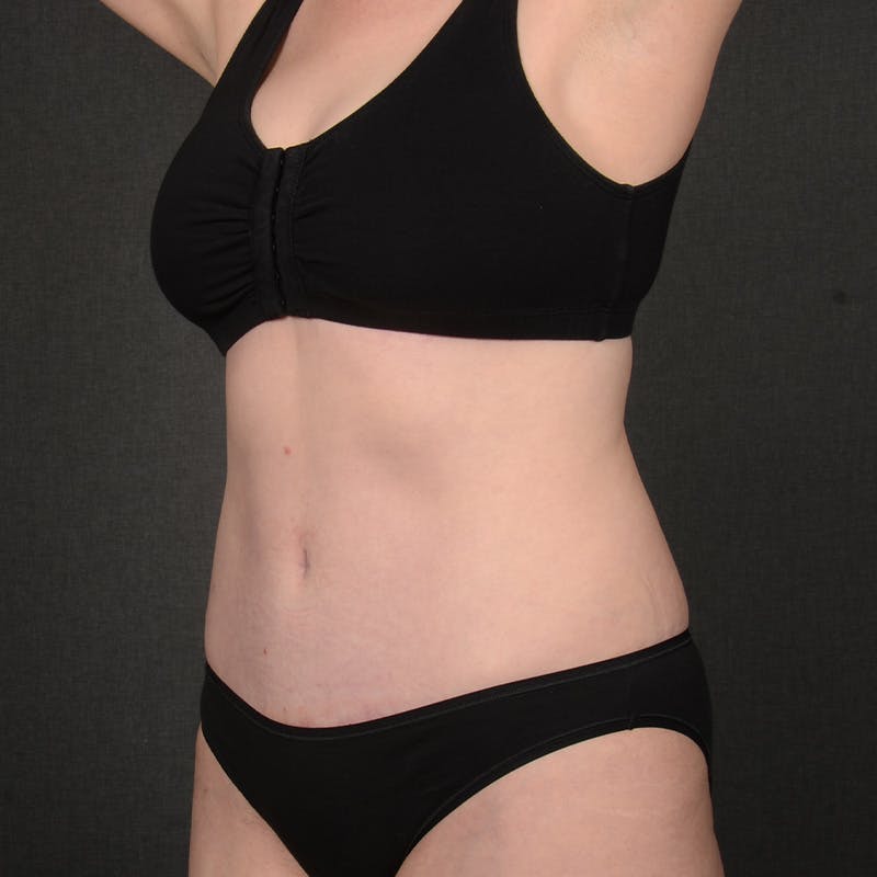 Tummy Tuck Before & After Gallery - Patient 860421 - Image 4