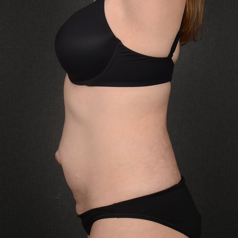 Tummy Tuck Before & After Gallery - Patient 860421 - Image 5