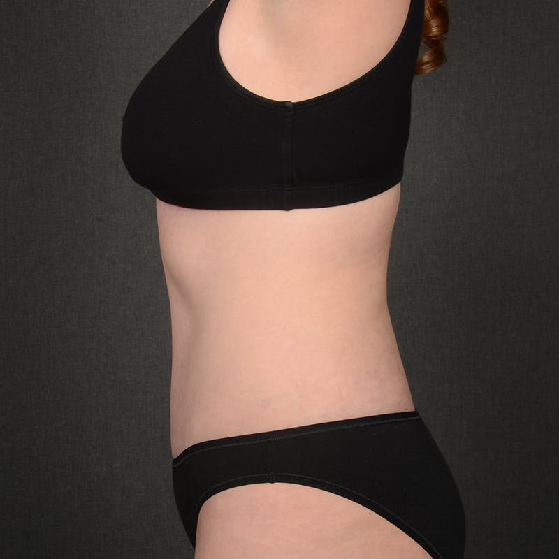 Tummy Tuck Before & After Gallery - Patient 860421 - Image 6
