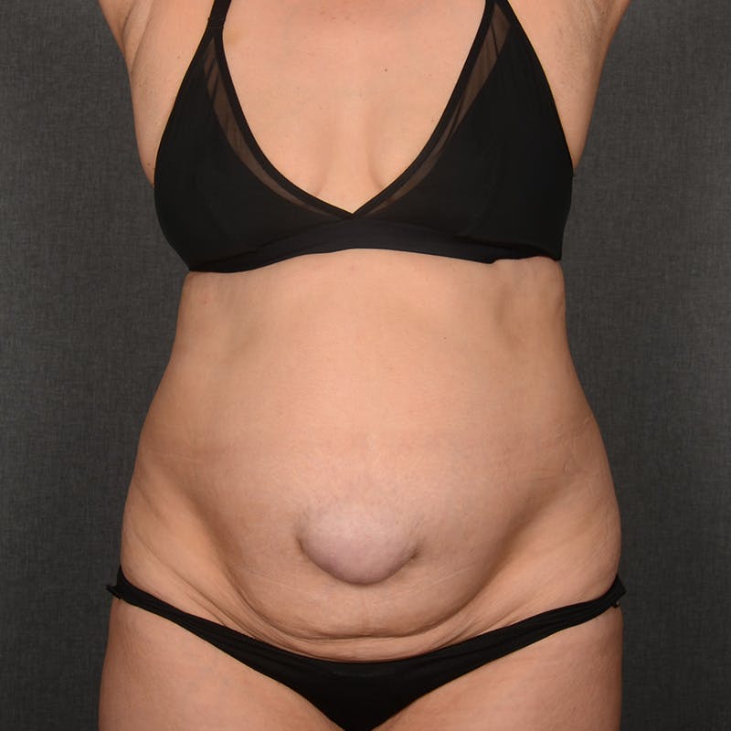 Tummy Tuck Before & After Gallery - Patient 292758 - Image 1