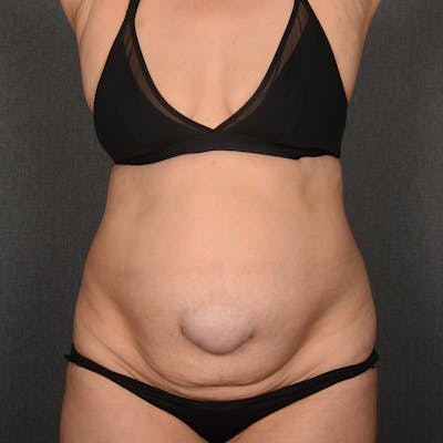 Tummy Tuck Before & After Gallery - Patient 292758 - Image 1