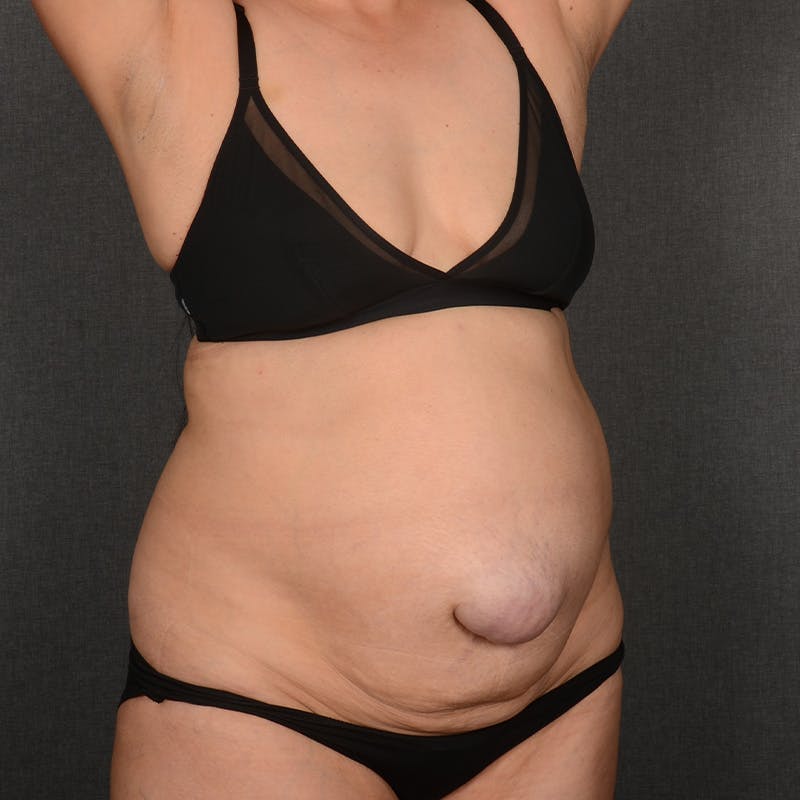 Tummy Tuck Before & After Gallery - Patient 292758 - Image 3