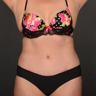 Tummy Tuck Before & After Gallery - Patient 292758 - Image 2