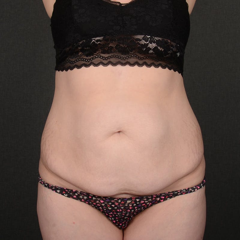 Tummy Tuck Before & After Gallery - Patient 240882 - Image 1