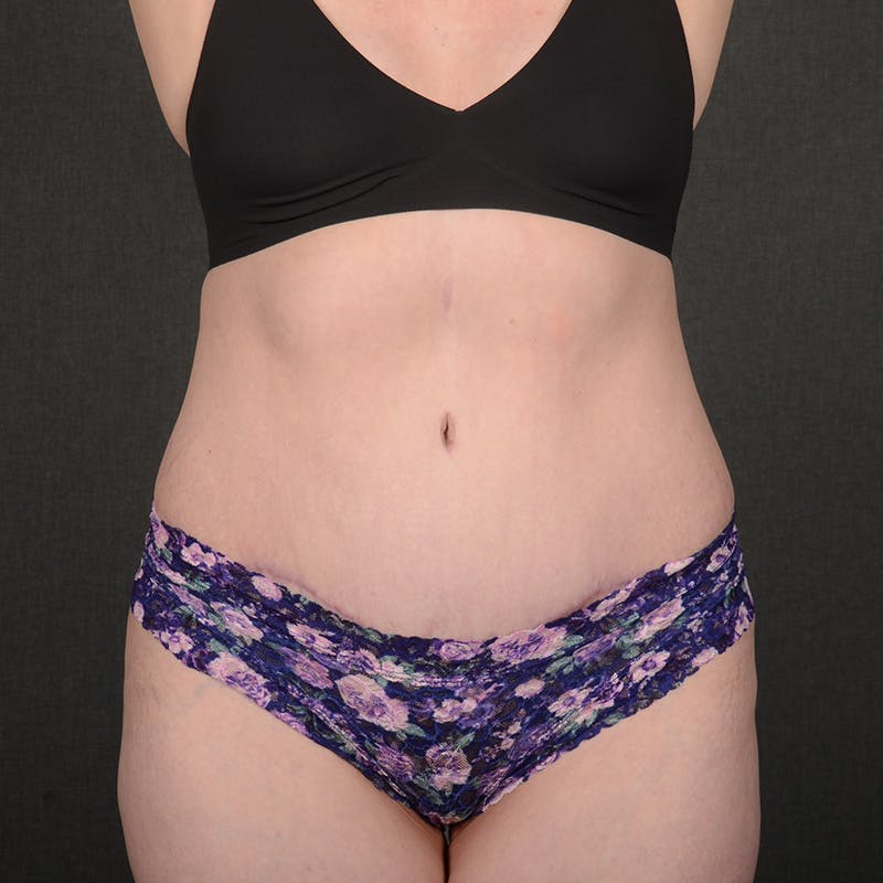 Tummy Tuck Before & After Gallery - Patient 240882 - Image 2