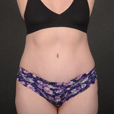 Tummy Tuck Before & After Gallery - Patient 240882 - Image 2