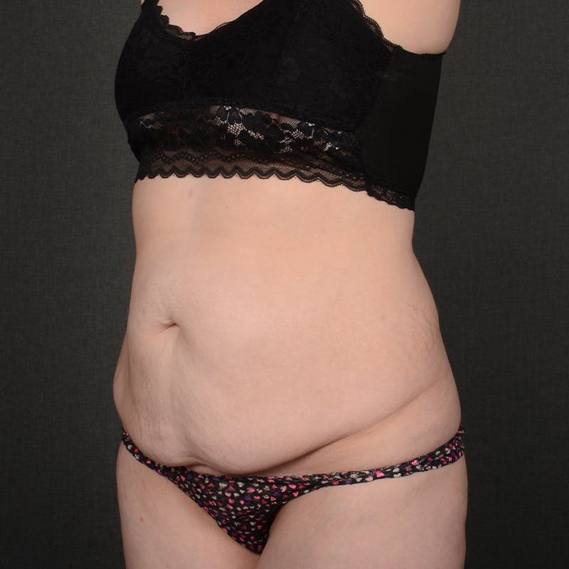 Tummy Tuck Before & After Gallery - Patient 240882 - Image 3