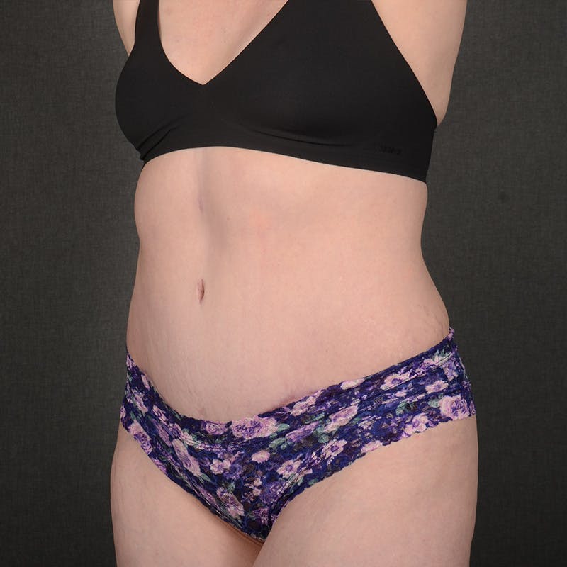 Tummy Tuck Before & After Gallery - Patient 240882 - Image 4