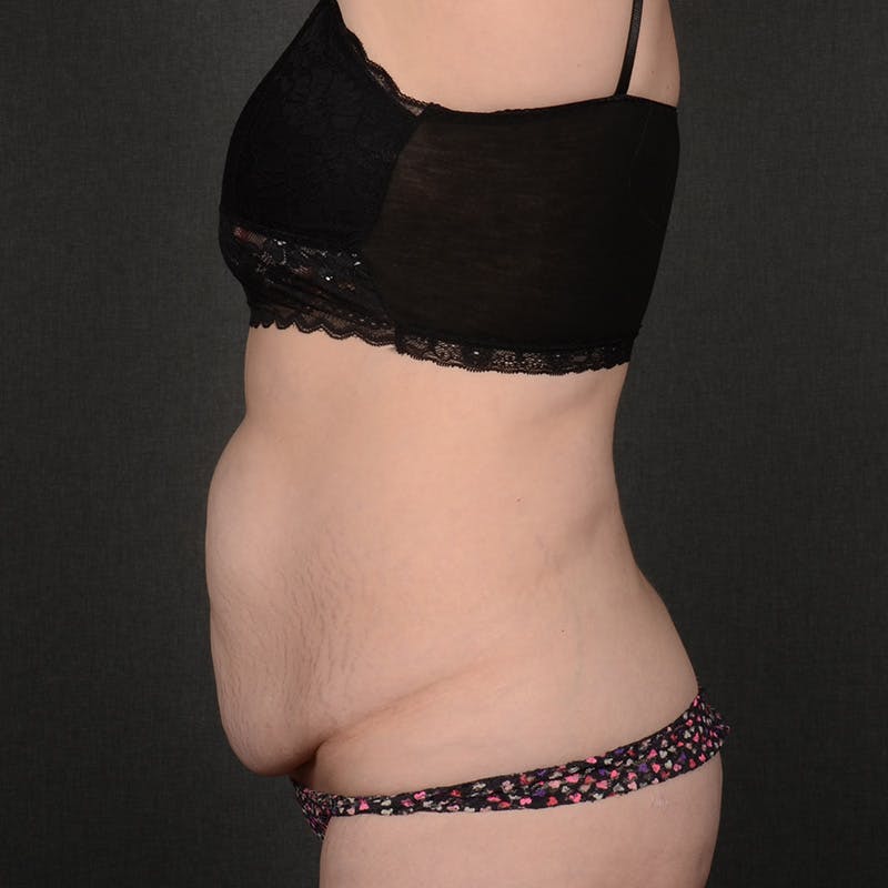 Tummy Tuck Before & After Gallery - Patient 240882 - Image 5