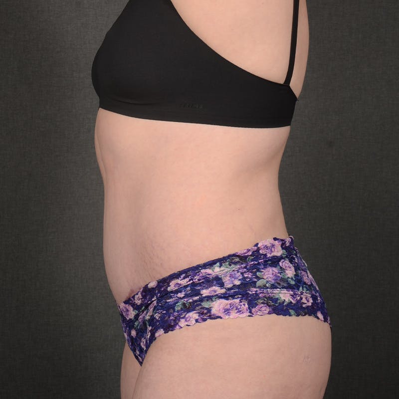 Tummy Tuck Before & After Gallery - Patient 240882 - Image 6