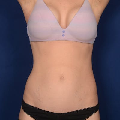 Tummy Tuck Before & After Gallery - Patient 750958 - Image 1