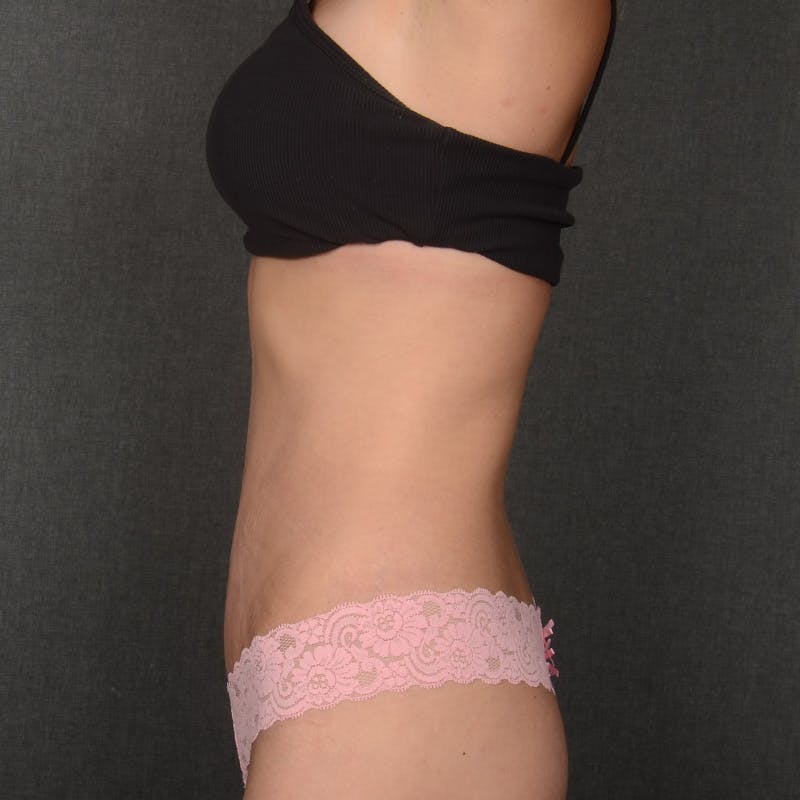 Tummy Tuck Before & After Gallery - Patient 750958 - Image 6