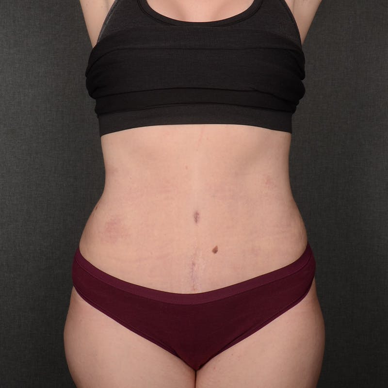Tummy Tuck Before & After Gallery - Patient 387927 - Image 2