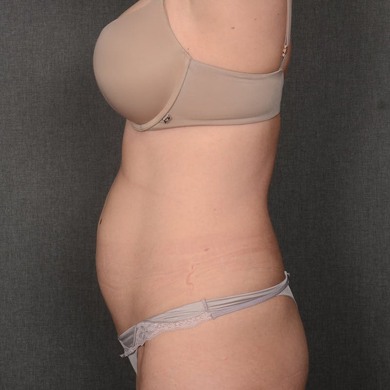 Tummy Tuck Before & After Gallery - Patient 387927 - Image 5