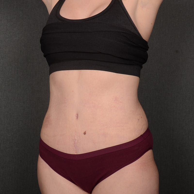 Tummy Tuck Before & After Gallery - Patient 387927 - Image 4