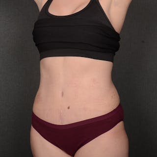 Tummy Tuck Before & After Gallery - Patient 387927 - Image 4