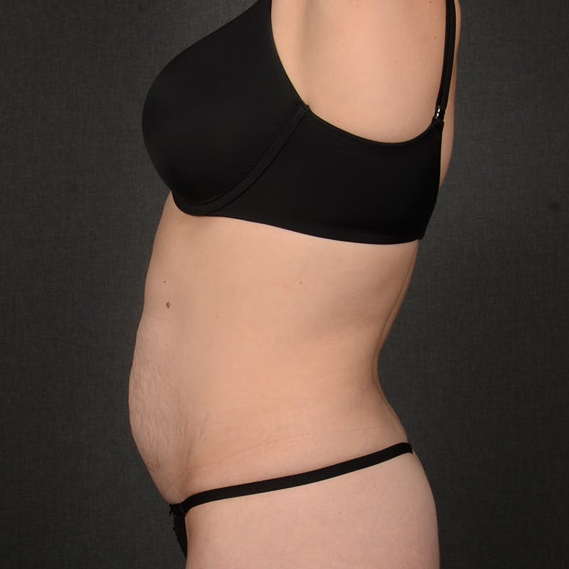 Tummy Tuck Before & After Gallery - Patient 687906 - Image 5