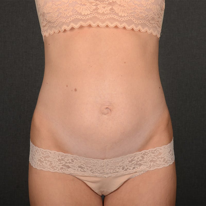 Tummy Tuck Before & After Gallery - Patient 233757 - Image 1