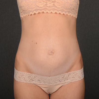 Tummy Tuck Before & After Gallery - Patient 233757 - Image 1