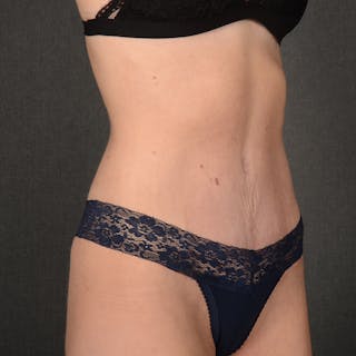 Tummy Tuck Before & After Gallery - Patient 233757 - Image 4