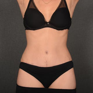 Tummy Tuck Before & After Gallery - Patient 428270 - Image 2