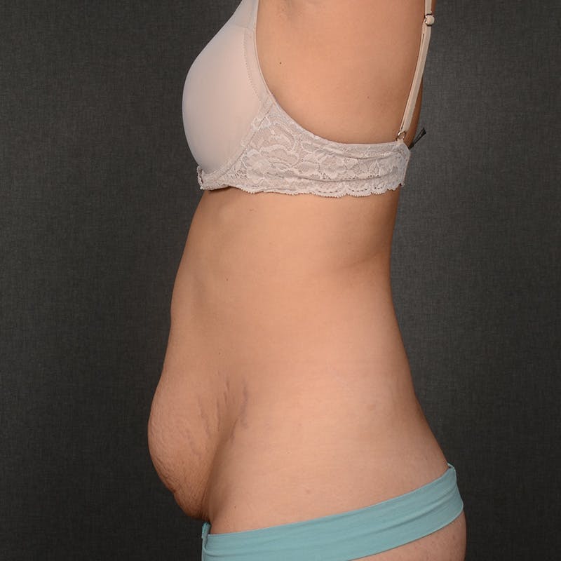 Tummy Tuck Before & After Gallery - Patient 428270 - Image 5