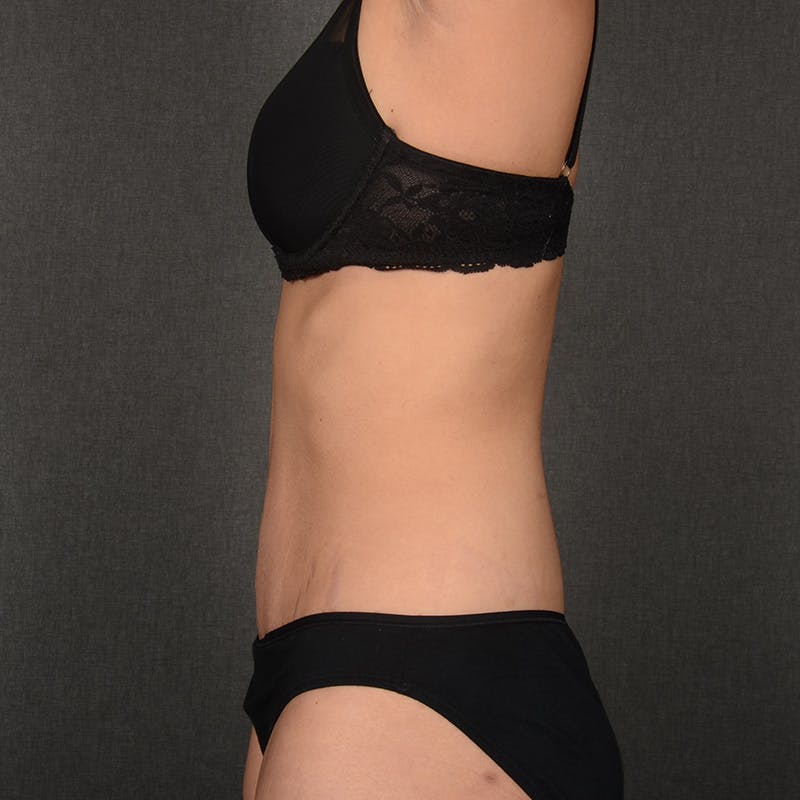 Tummy Tuck Before & After Gallery - Patient 428270 - Image 6