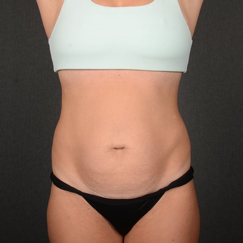 Tummy Tuck Before & After Gallery - Patient 146854 - Image 1