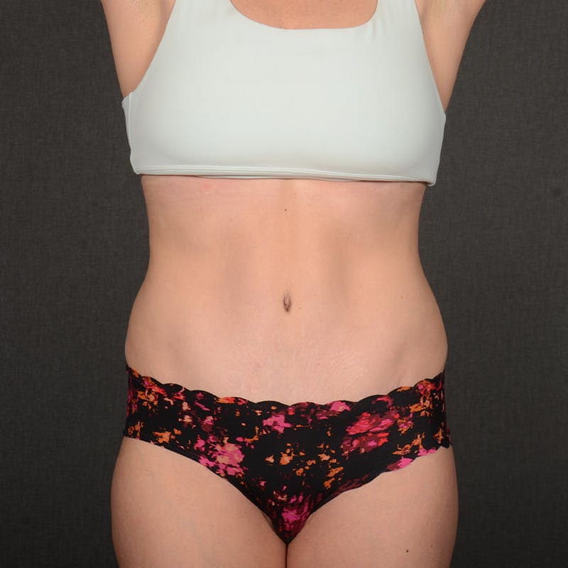 Tummy Tuck Before & After Gallery - Patient 146854 - Image 2