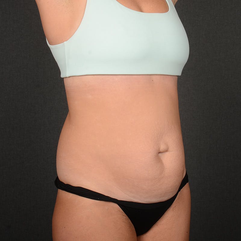 Tummy Tuck Before & After Gallery - Patient 146854 - Image 3