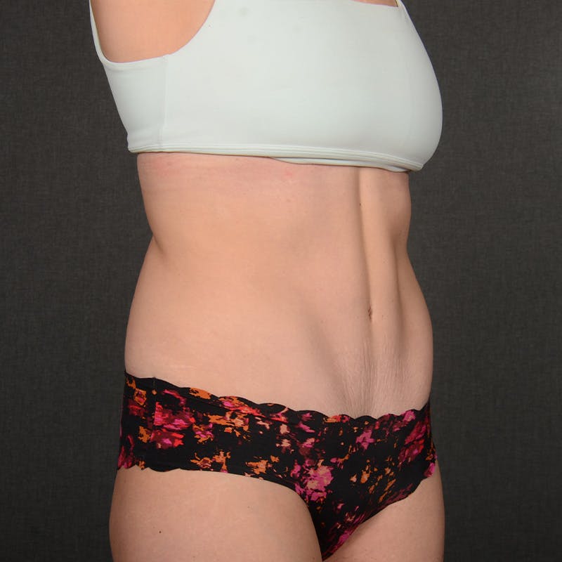 Tummy Tuck Before & After Gallery - Patient 146854 - Image 4