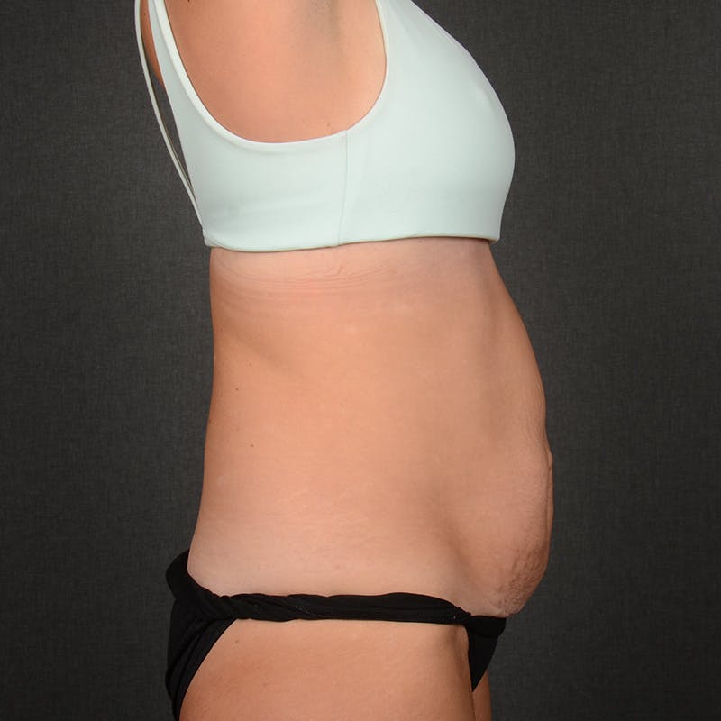 Tummy Tuck Before & After Gallery - Patient 146854 - Image 5