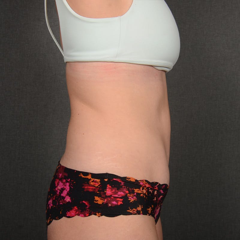 Tummy Tuck Before & After Gallery - Patient 146854 - Image 6
