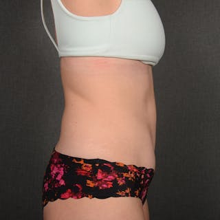 Tummy Tuck Before & After Gallery - Patient 146854 - Image 6