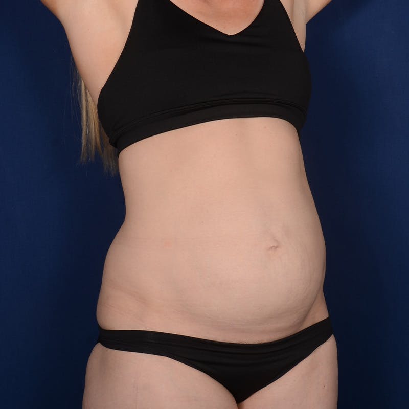 Tummy Tuck Before & After Gallery - Patient 243026 - Image 3
