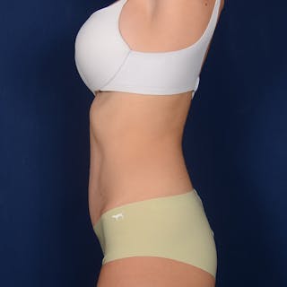Tummy Tuck Before & After Gallery - Patient 491518 - Image 6