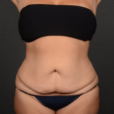 Tummy Tuck Before & After Gallery - Patient 310545 - Image 1