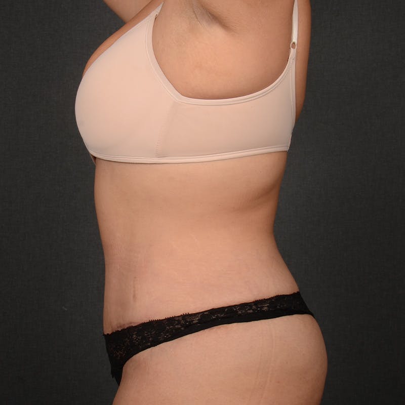 Tummy Tuck Before & After Gallery - Patient 310545 - Image 6