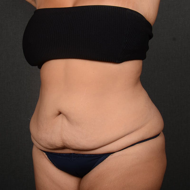 Tummy Tuck Before & After Gallery - Patient 310545 - Image 3