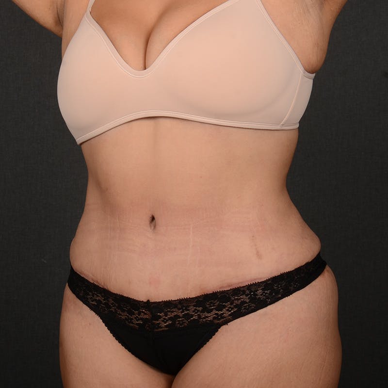 Tummy Tuck Before & After Gallery - Patient 310545 - Image 4