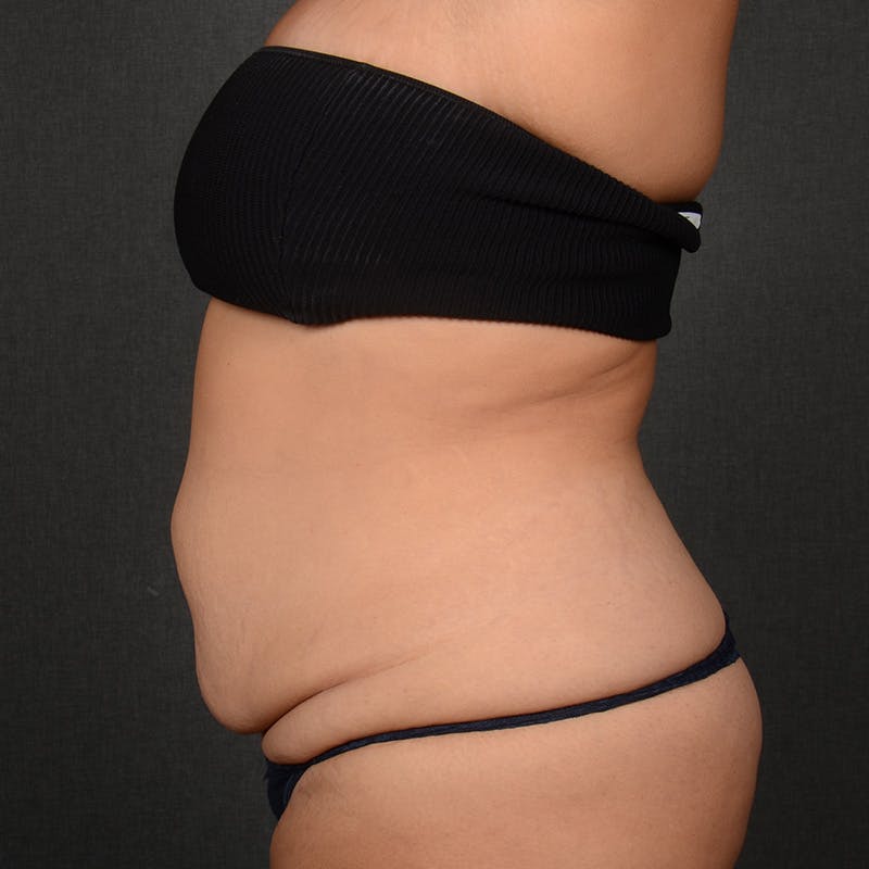 Tummy Tuck Before & After Gallery - Patient 310545 - Image 5