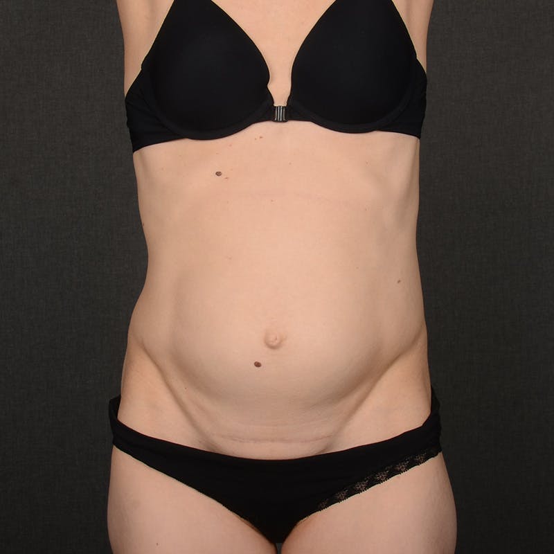 Tummy Tuck Before & After Gallery - Patient 289605 - Image 1
