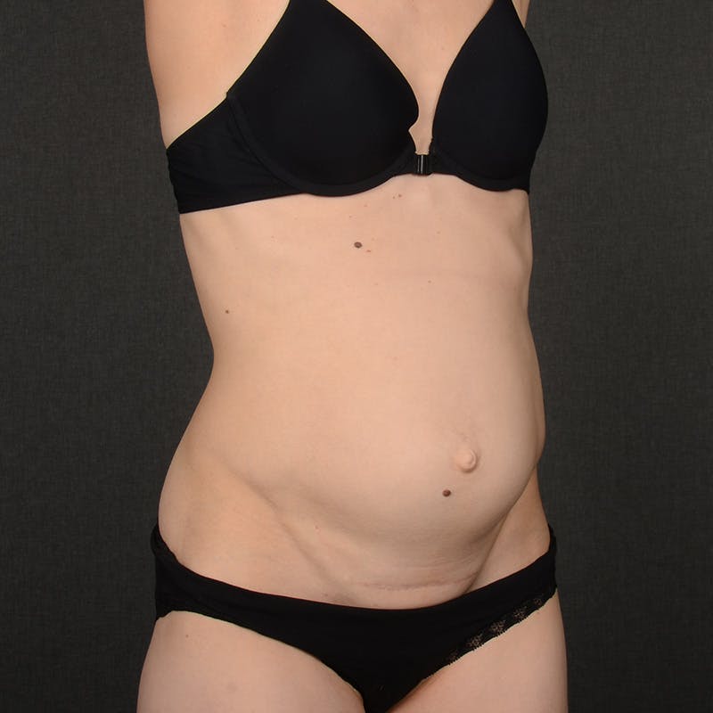 Tummy Tuck Before & After Gallery - Patient 289605 - Image 3