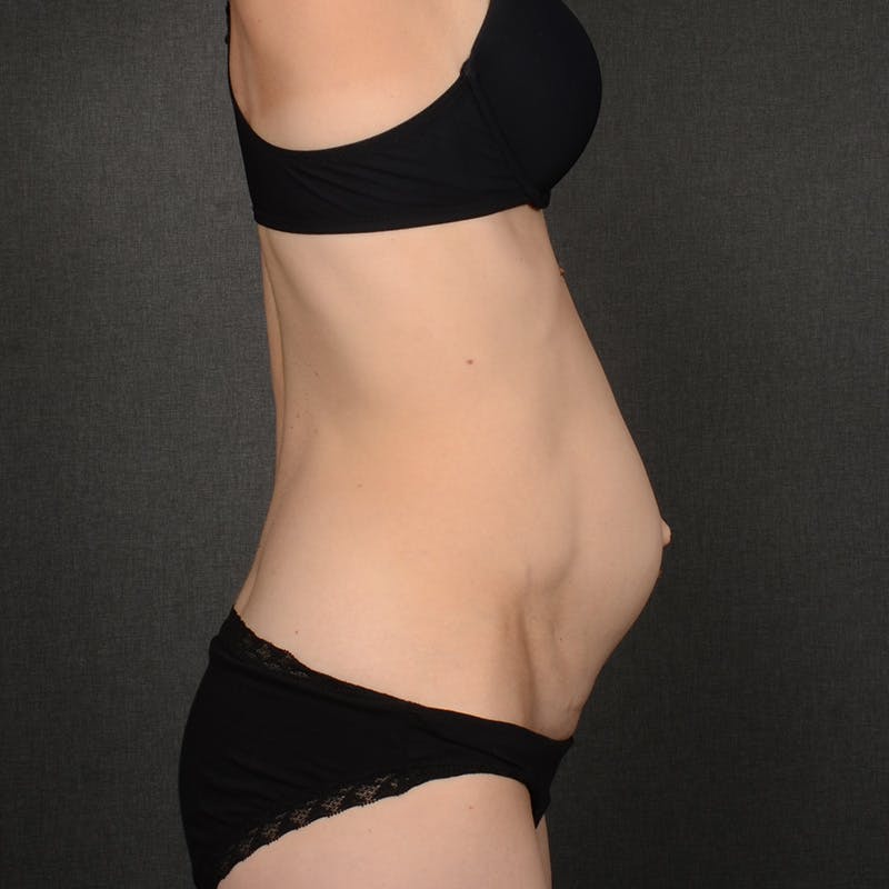 Tummy Tuck Before & After Gallery - Patient 289605 - Image 5
