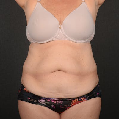 Tummy Tuck Before & After Gallery - Patient 185819 - Image 1