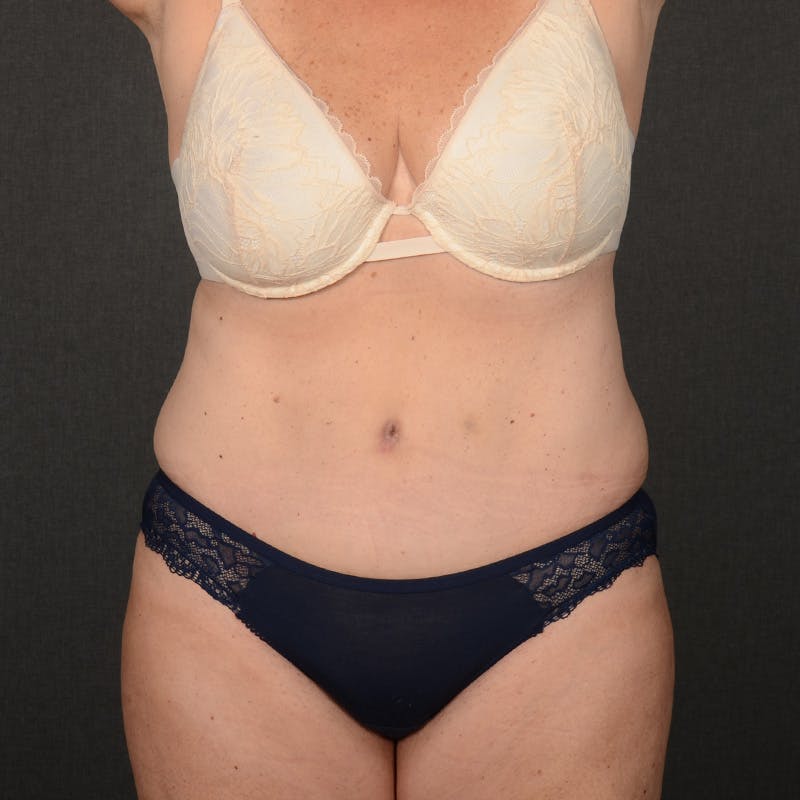 Tummy Tuck Before & After Gallery - Patient 185819 - Image 2