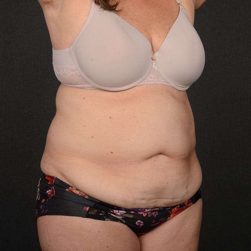 Tummy Tuck Before & After Gallery - Patient 185819 - Image 3