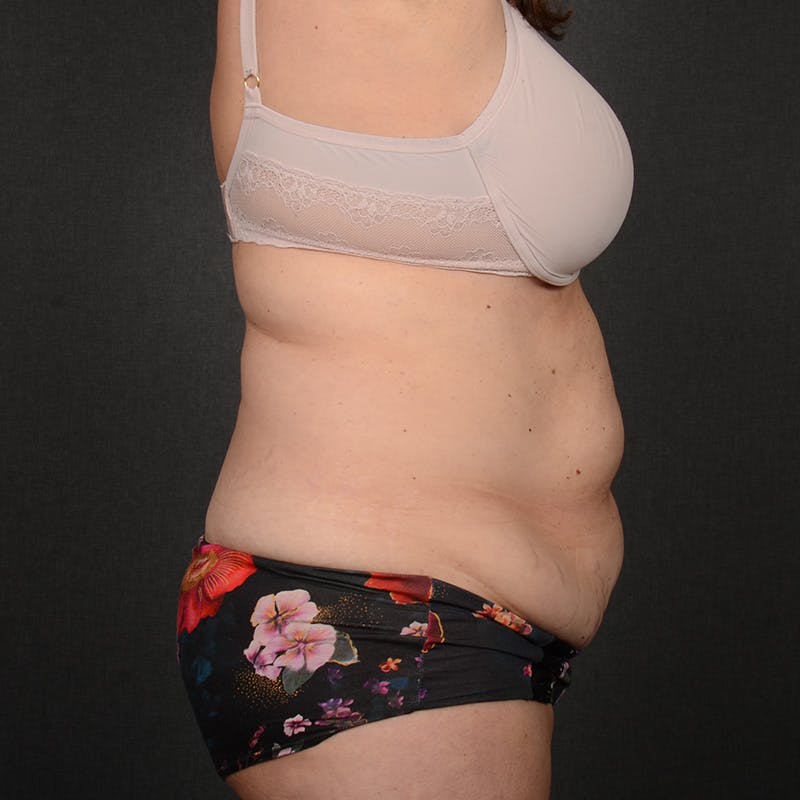 Tummy Tuck Before & After Gallery - Patient 185819 - Image 5