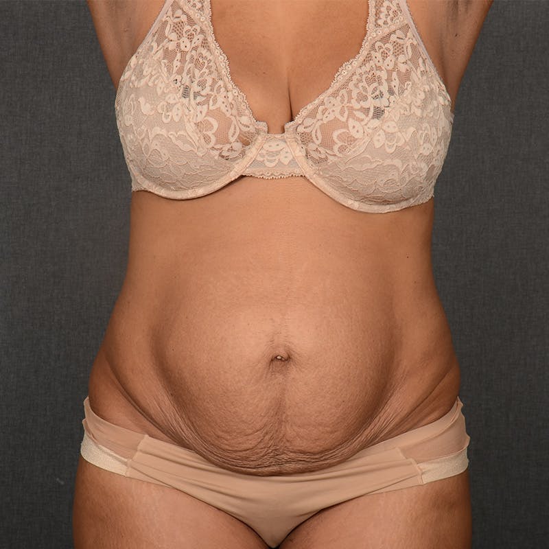 Tummy Tuck Before & After Gallery - Patient 290981 - Image 1